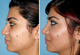 Asian Nose Surgery