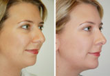 How Much is Nose Surgery
