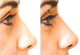 How to Shape Nose without Surgery