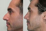 Men Nose Surgery