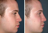 Nose Job without Surgery