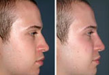 Nose Straightening Surgery
