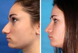 Nose Surgery Birmingham