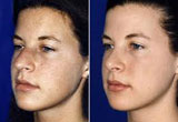 Nose Surgery Glasgow