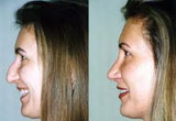 Nose Surgery Kent