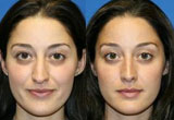 Nose Surgery Manchester