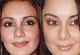 Plastic Surgery for the Nose