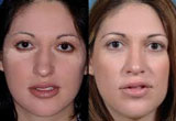 Reconstructive Nose Surgery